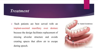 Treatment
 Such patients are best served with an
implant-assisted maxillary over denture
because the design facilitates replacement of
missing alveolar structure and avoids
creating spaces that allow air to escape
during speech.
 