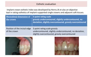 Esthetic evaluation
Mesiodistal dimension of
the crown
5-point rating scale
grossly undercontoured, slightly undercontoured, no
deviation, slightly overcontoured, grossly overcontoured
Position of the incisal edge
of the crown
5-point rating scale grossly
undercontoured, slightly undercontoured, no deviation,
slightly overcontoured, grossly overcontoured
Implant crown esthetic index was developed by Henry JA et alas an objective
tool in rating esthetics of implant-supported single crowns and adjacent soft tissues.
 