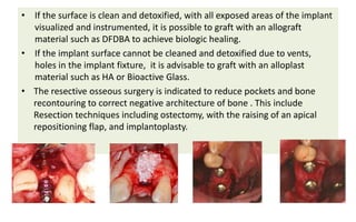 • If the surface is clean and detoxified, with all exposed areas of the implant
visualized and instrumented, it is possible to graft with an allograft
material such as DFDBA to achieve biologic healing.
• If the implant surface cannot be cleaned and detoxified due to vents,
holes in the implant fixture, it is advisable to graft with an alloplast
material such as HA or Bioactive Glass.
• The resective osseous surgery is indicated to reduce pockets and bone
recontouring to correct negative architecture of bone . This include
Resection techniques including ostectomy, with the raising of an apical
repositioning flap, and implantoplasty.
 