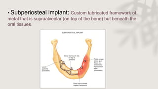 • Subperiosteal implant: Custom fabricated framework of
metal that is supraalveolar (on top of the bone) but beneath the
oral tissues.
 