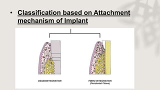 • Classification based on Attachment
mechanism of Implant
 