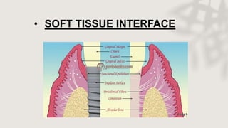• SOFT TISSUE INTERFACE
 