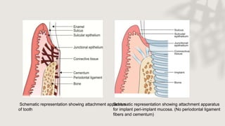 Schematic representation showing attachment apparatus
for implant peri-implant mucosa. (No periodontal ligament
fibers and cementum)
Schematic representation showing attachment apparatus
of tooth
 