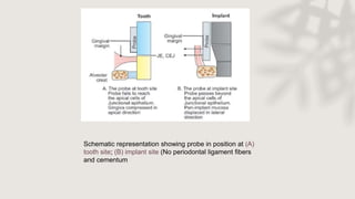 Schematic representation showing probe in position at (A)
tooth site; (B) implant site (No periodontal ligament fibers
and cementum
 