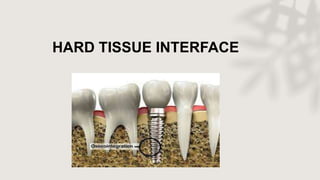 HARD TISSUE INTERFACE
 