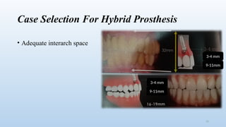 IMPLANT HYBRID MILLED PROSTHESIS all on 4 or all on X | PPTX