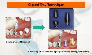 Healing Caps Removed
Closed Tray Technique
Attaching The Transfer Copings (Verified radiographically)
 