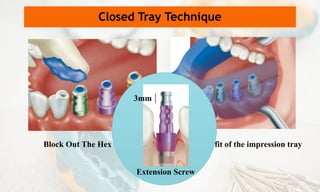 Block Out The Hex Holes
Closed Tray Technique
Verifying the fit of the impression tray
Extension Screw
3mm |
 