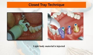 Closed Tray Technique
Light body material is injected
 