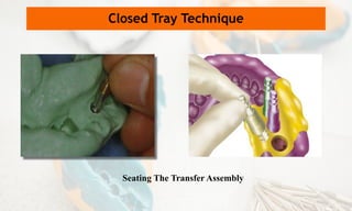 Closed Tray Technique
Seating The Transfer Assembly
 