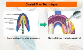 Closed Tray Technique
Cross section of transfer impression Place soft tissue replication material
 