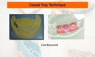 Cast Recovered
Closed Tray Technique
 