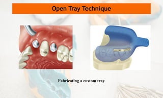 Fabricating a custom tray
Open Tray Technique
 