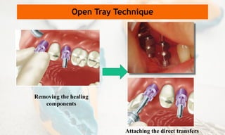Removing the healing
components
Open Tray Technique
Attaching the direct transfers
 