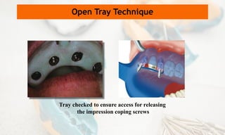 Tray checked to ensure access for releasing
the impression coping screws
Open Tray Technique
 