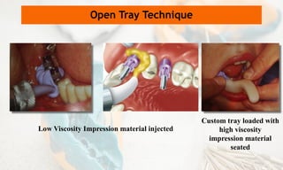 Low Viscosity Impression material injected
Custom tray loaded with
high viscosity
impression material
seated
Open Tray Technique
 