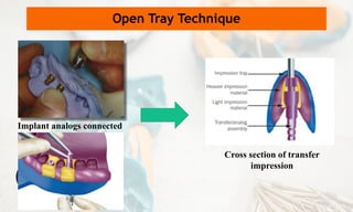 Implant analogs connected
Open Tray Technique
Cross section of transfer
impression
 