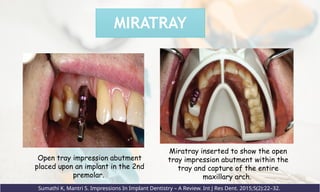 MIRATRAY
Open tray impression abutment
placed upon an implant in the 2nd
premolar.
Miratray inserted to show the open
tray impression abutment within the
tray and capture of the entire
maxillary arch.
Sumathi K, Mantri S. Impressions In Implant Dentistry – A Review. Int J Res Dent. 2015;5(2):22–32.
 