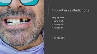 Implant in aesthetic zone
Early delayed .
• bone graft .
• tissue graft.
• scan body.
• Dr. Absi DDS
 