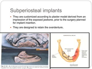Subperiosteal implants
 They are customized according to plaster model derived from an
impression of the exposed jawbone, prior to the surgery planned
for implant insertion.
 They are designed to retain the overdenture.
 