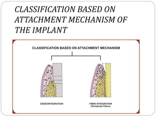 CLASSIFICATION BASED ON
ATTACHMENT MECHANISM OF
THE IMPLANT
 