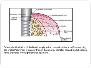 a
Schematic illustration of the blood supply in the connective tissue cuff surrounding
the implant/abutment is scarcer than in the gingival complex around teeth because
none originates from a periodontal ligament.
 
