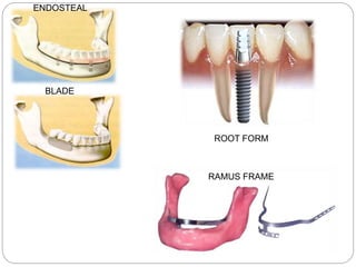 ENDOSTEAL
BLADE
RAMUS FRAME
ROOT FORM
 