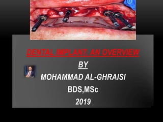 DENTAL IMPLANT: AN OVERVIEW
BY
MOHAMMAD AL-GHRAISI
BDS,MSc
2019
 