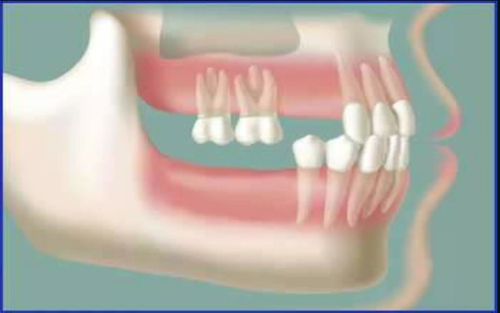 •With top premolars missing and
premolars have no opposing force
so they continue to erupt
 