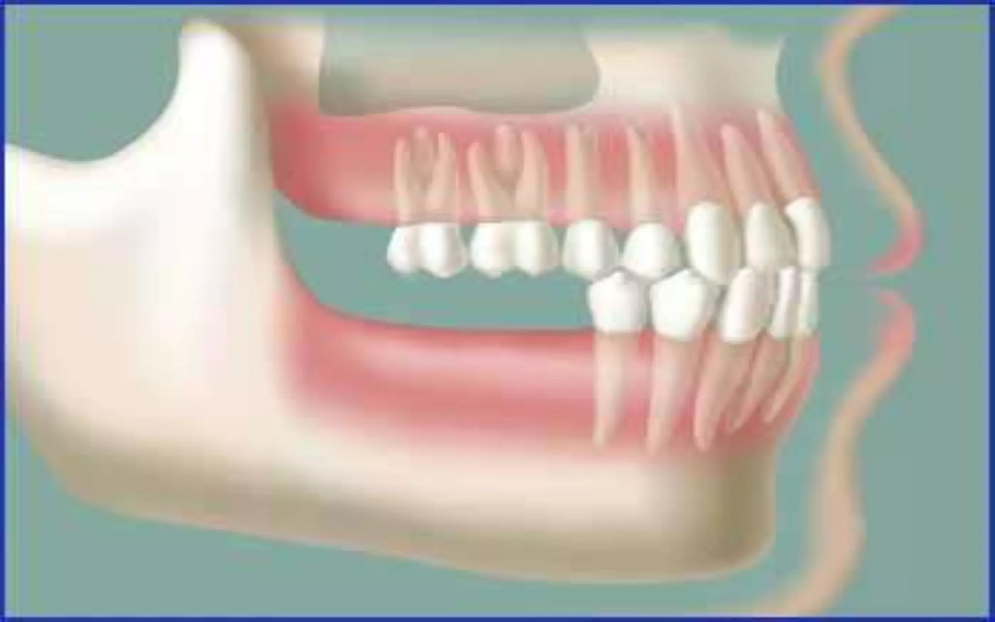 •2 lower molars missing
 