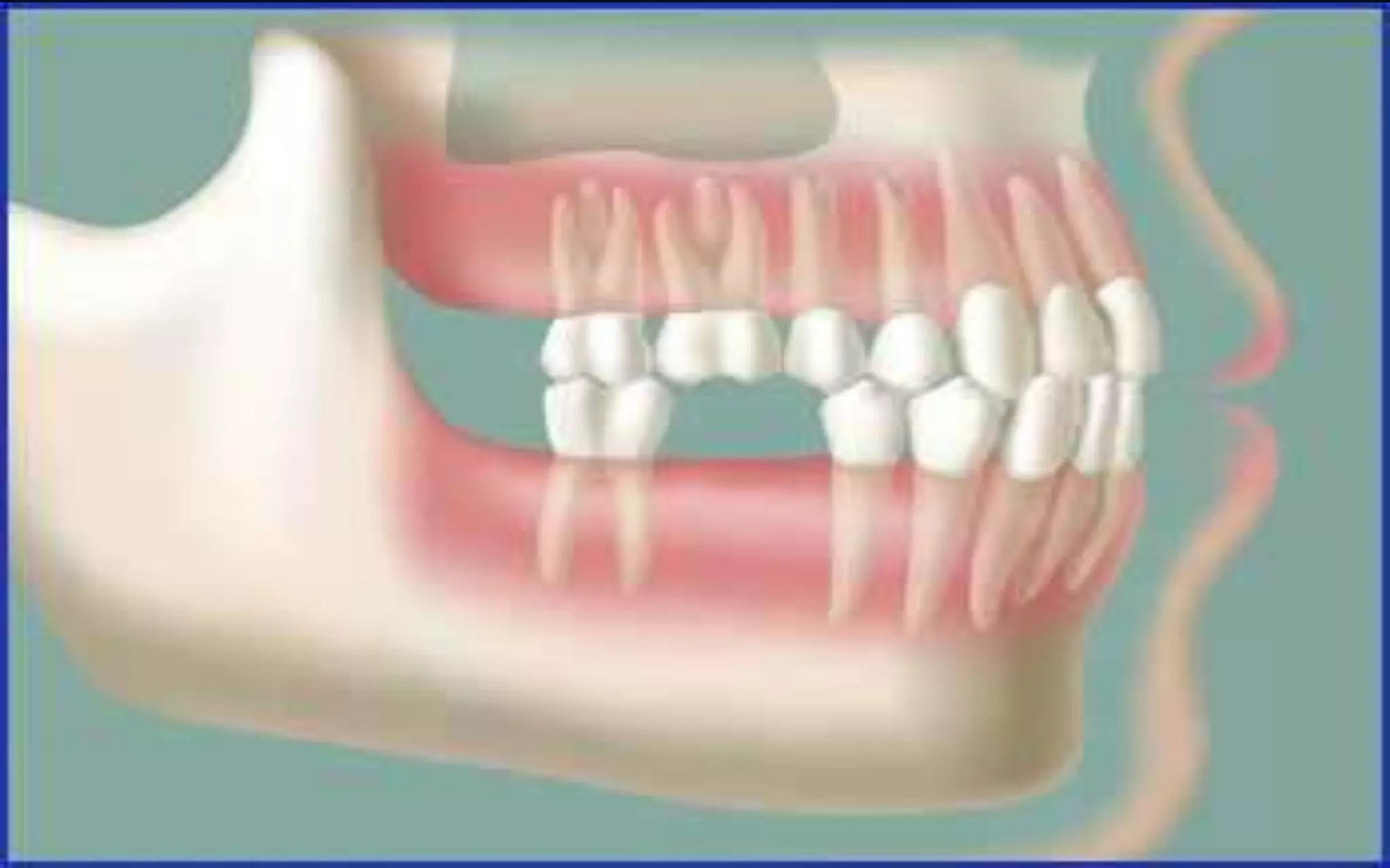 •Missing lower molar
 