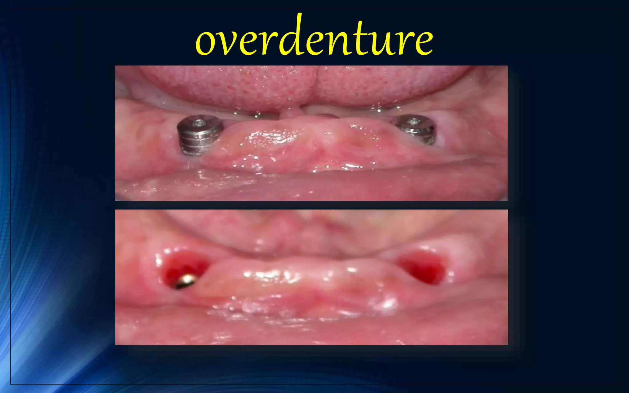overdenture
 