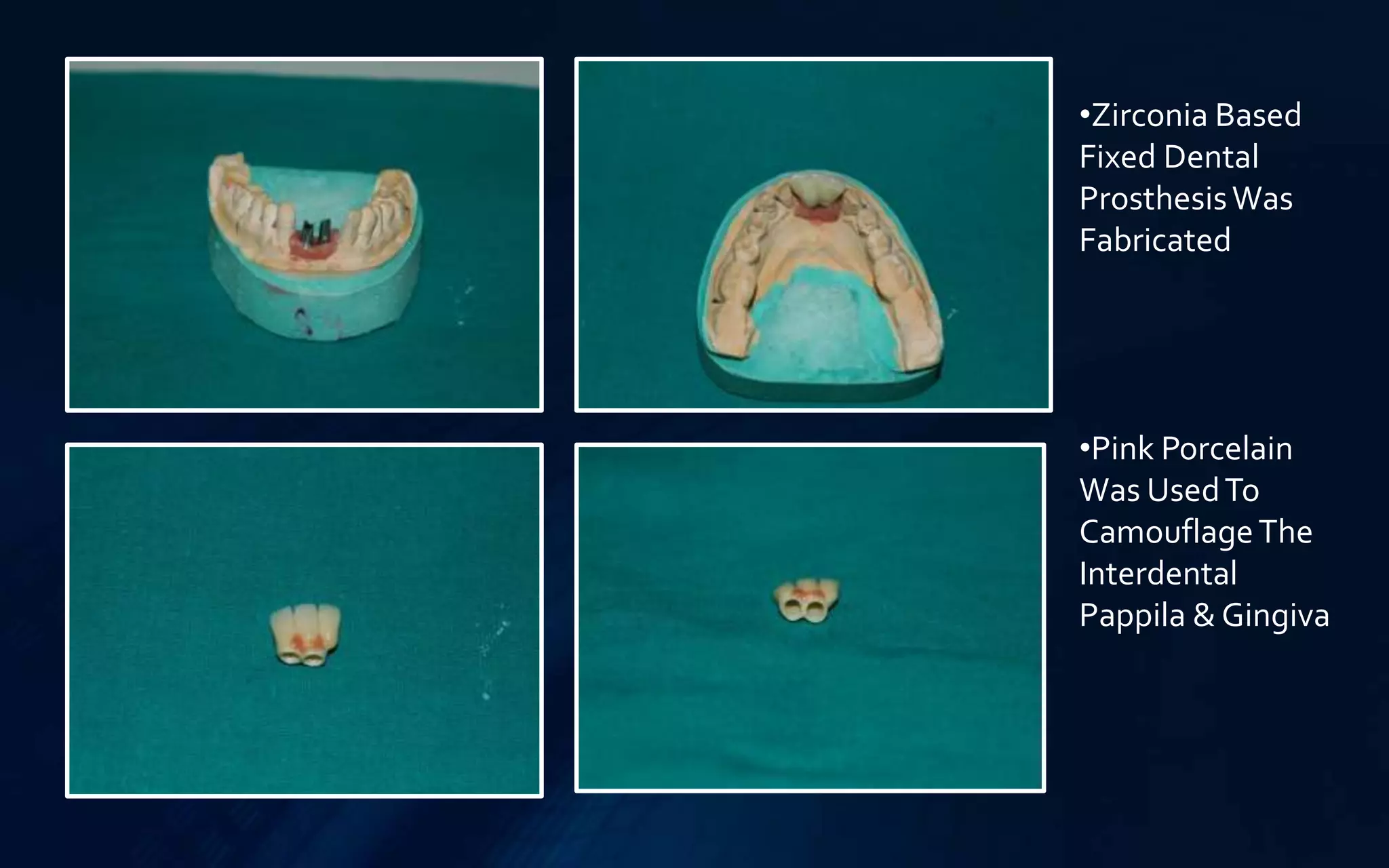 •Zirconia Based
Fixed Dental
ProsthesisWas
Fabricated
•Pink Porcelain
Was UsedTo
CamouflageThe
Interdental
Pappila & Gingiva
 