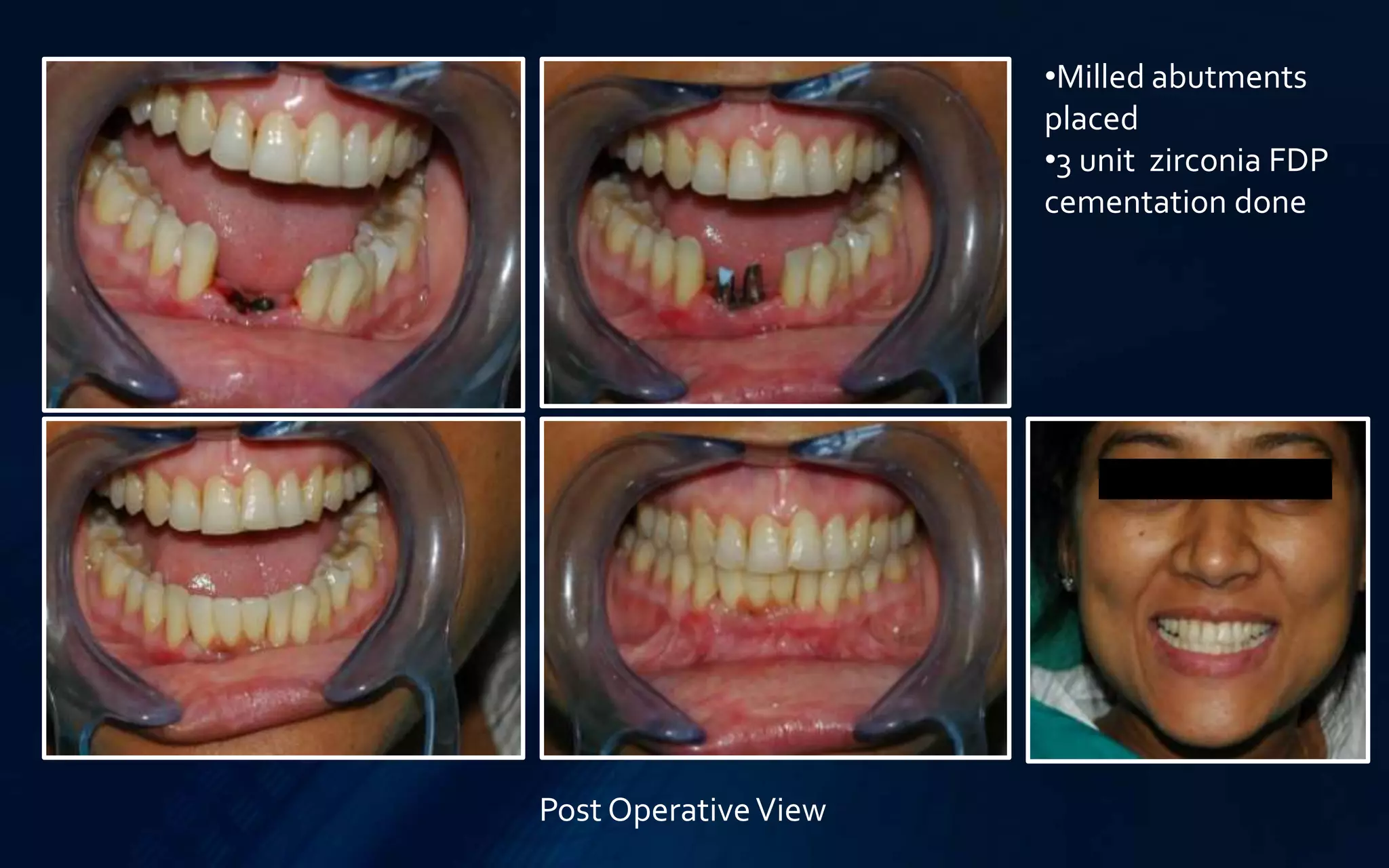 •Milled abutments
placed
•3 unit zirconia FDP
cementation done
Post OperativeView
 