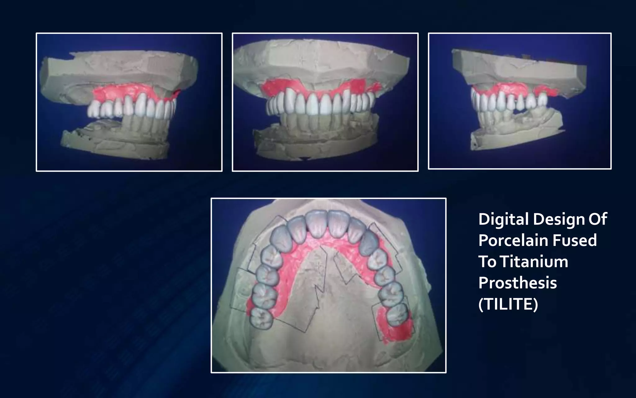 Digital Design Of
Porcelain Fused
ToTitanium
Prosthesis
(TILITE)
 