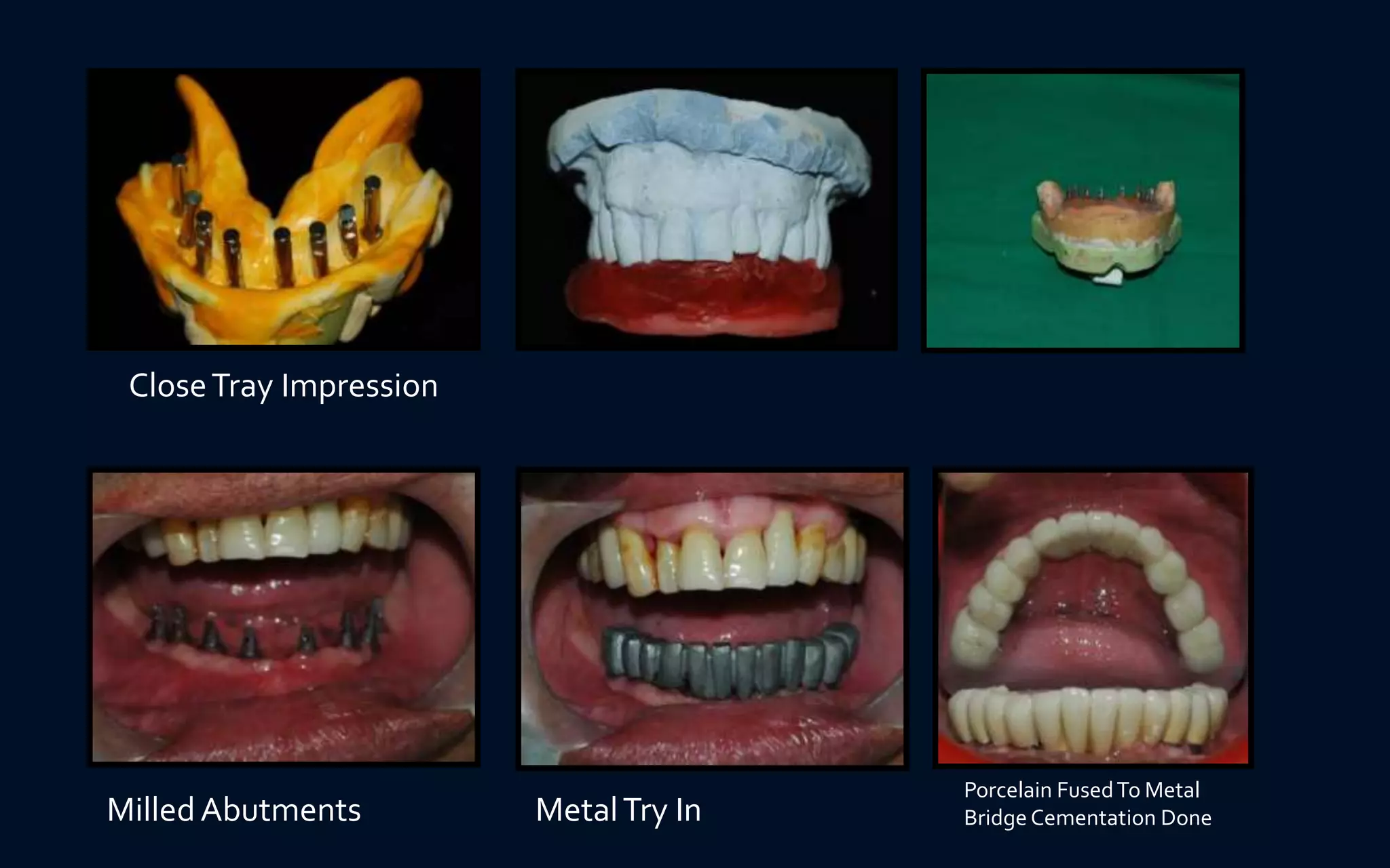 CloseTray Impression
MilledAbutments MetalTry In
Porcelain FusedTo Metal
Bridge Cementation Done
 