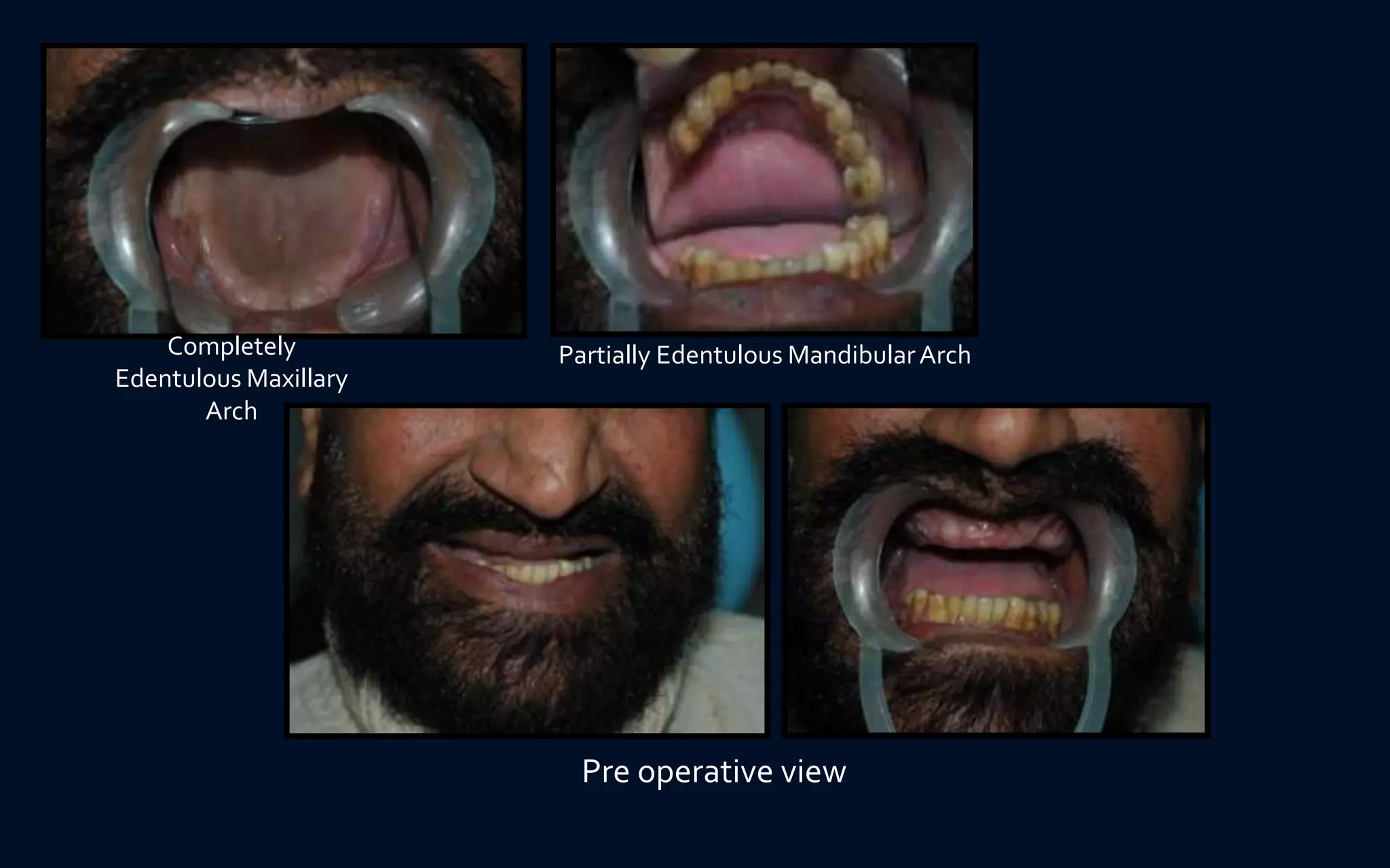 Pre operative view
Completely
Edentulous Maxillary
Arch
Partially Edentulous MandibularArch
 