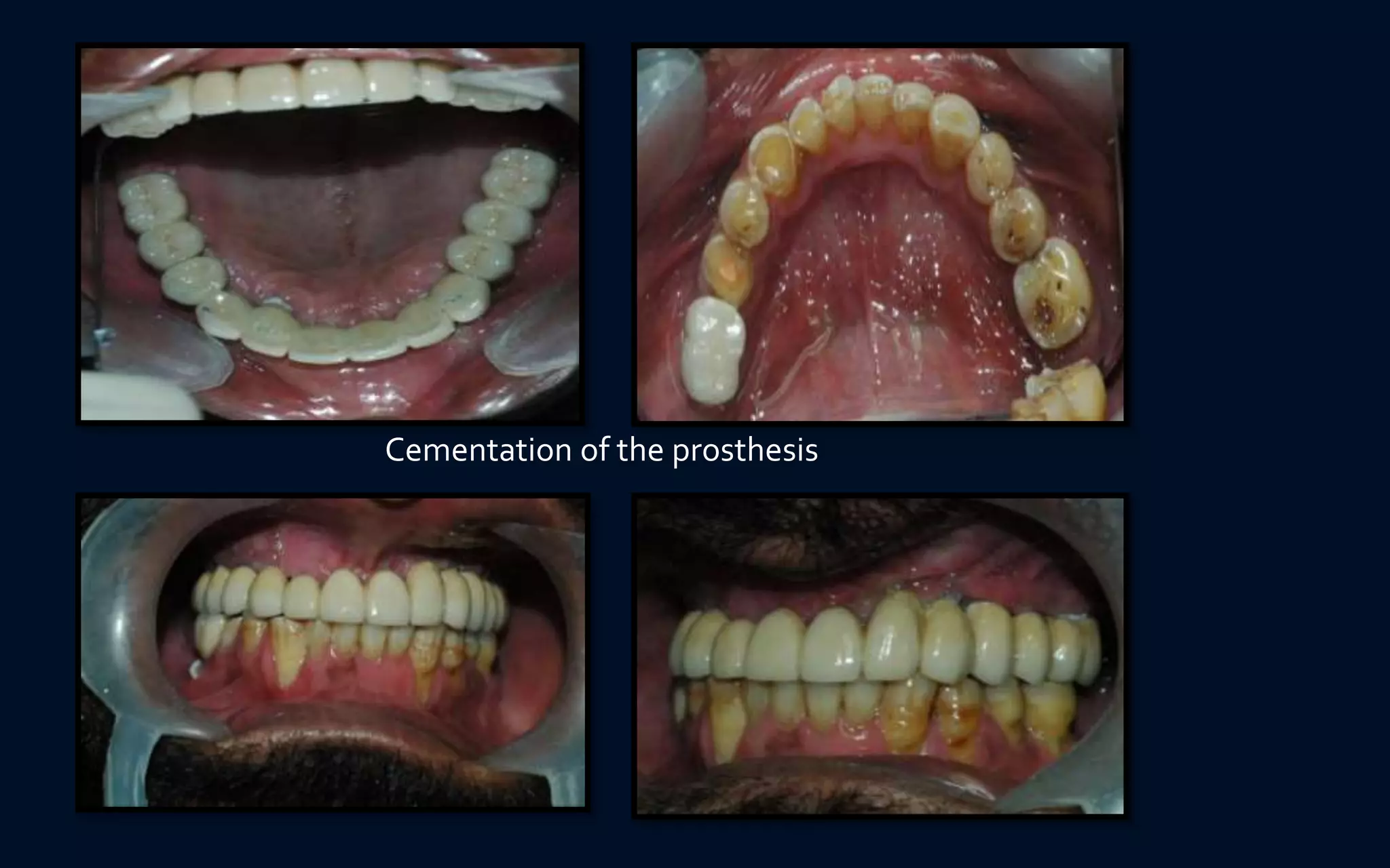 Cementation of the prosthesis
 