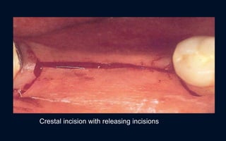 Implant lecture | PPTX