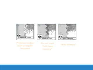 Premature loading
leads to implant
movement
The end result
“Soft tissue
interface”
“Bony interface”
 