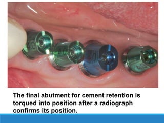 The final abutment for cement retention is
torqued into position after a radiograph
confirms its position.
 