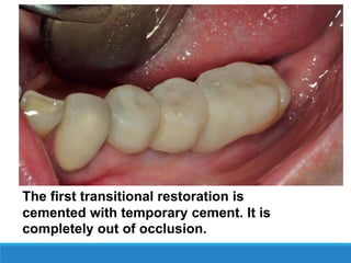 The first transitional restoration is
cemented with temporary cement. It is
completely out of occlusion.
 