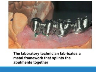 The laboratory technician fabricates a
metal framework that splints the
abutments together
 