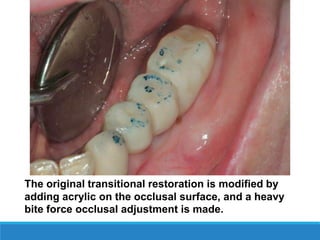 The original transitional restoration is modified by
adding acrylic on the occlusal surface, and a heavy
bite force occlusal adjustment is made.
 