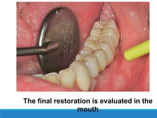 The final restoration is evaluated in the
mouth
 