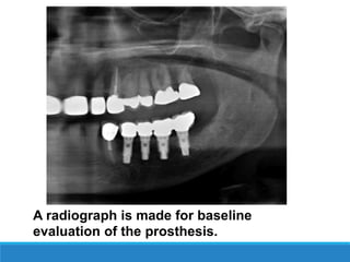 A radiograph is made for baseline
evaluation of the prosthesis.
 