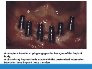 A two-piece transfer coping engages the hexagon of the implant
body.
A closed-tray impression is made with the customized impression
tray over these implant body transfers
 