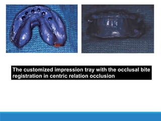 The customized impression tray with the occlusal bite
registration in centric relation occlusion
 