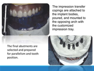 The impression transfer
copings are attached to
the implant bodies,
poured, and mounted to
the opposing arch with
the customized
impression tray.
The final abutments are
selected and prepared
for parallelism and tooth
position.
 