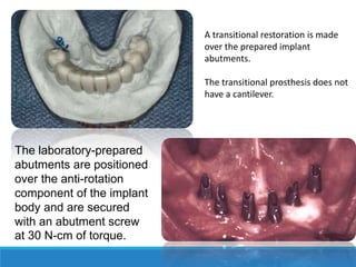 A transitional restoration is made
over the prepared implant
abutments.
The transitional prosthesis does not
have a cantilever.
The laboratory-prepared
abutments are positioned
over the anti-rotation
component of the implant
body and are secured
with an abutment screw
at 30 N-cm of torque.
 